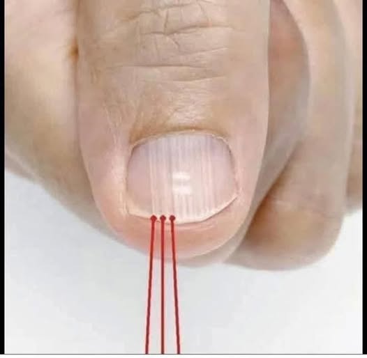 Mulghbas Rigeus Understanding the Real Causes of Vertical Ridges on Your Nails - News ...