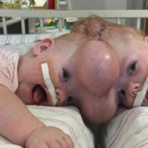 conjoined-twins-going-home